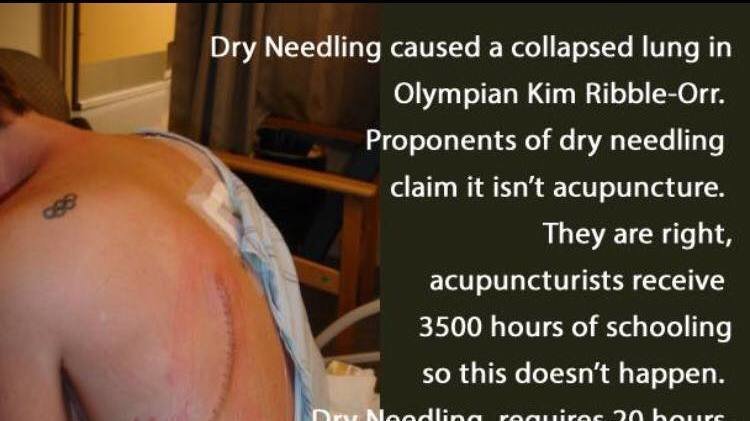 Another dry needling mistake.
