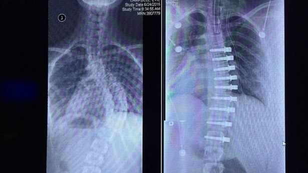 Petition · Justin Trudeau: We want to end spinal fusion if it is not absolutely necessary ...