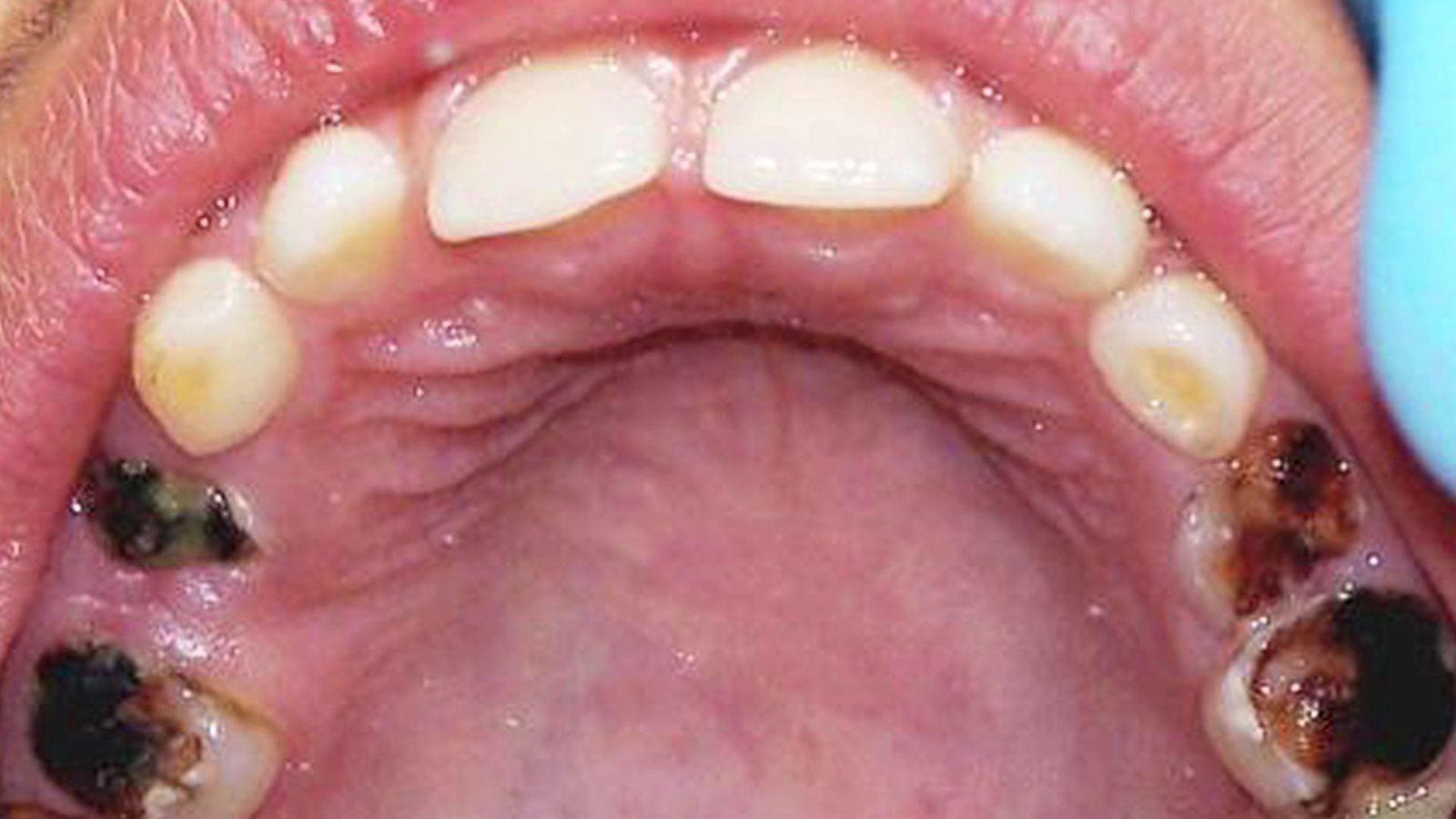 Petition · Better dental coverage for adults on Medicaid/ Medicare in Nevada Reno, United