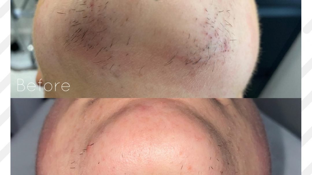 Petition · Demand insurance covered hair removal for woman who suffer from PCOS United States