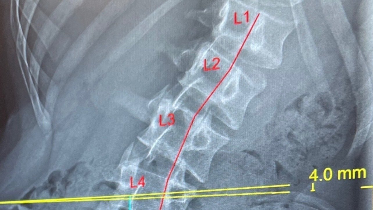 Petition · BRING BACK SCOLIOSIS SCREENING TO SCHOOLS United Kingdom