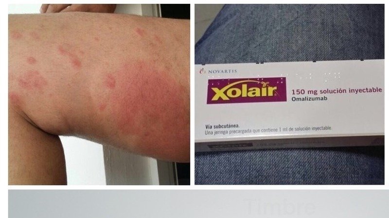 urticaria subita