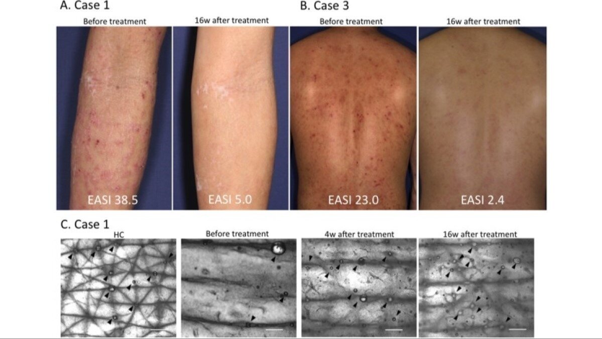 Petition · Subsidize Dupixent Treatment for Severe Eczema Patients in