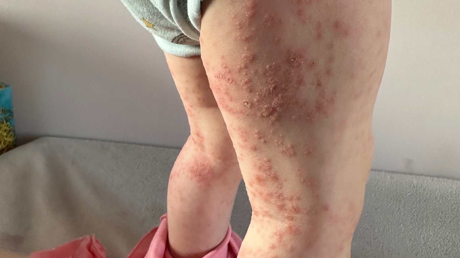 Petition · Change guidance on staff with Herpes Simplex 1 (cold sores